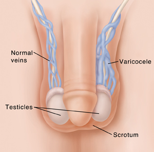 Penis, scrotum and testicles showing normal veins and varicocele.