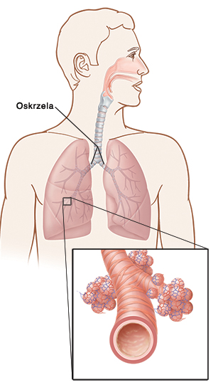 oskrzela