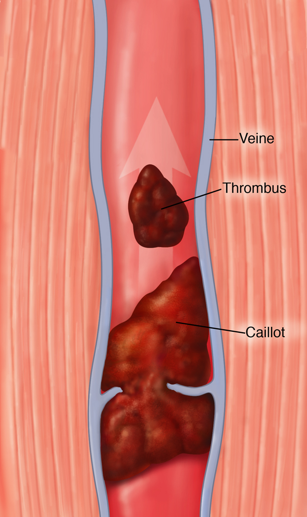 Veine avec caillot sanguin et embole à l'intérieur. Les étiquettes sont : Veine, thrombose et caillot.