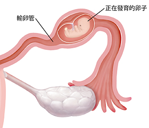 在宮外孕的情況下，有胚胎在裡面發育的輸卵管放大剖面圖。