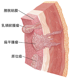 膀胱壁剖面圖,顯示粘膜層、黏膜下層、肌層、脂肪、和三種癌症:乳頭狀腫瘤,無蒂腫瘤,和原位腫瘤。