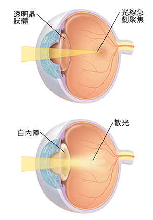 3/4 眼球視圖，顯示晶狀體急劇聚焦光線。3/4 眼球視圖，顯示白內障散射光線。