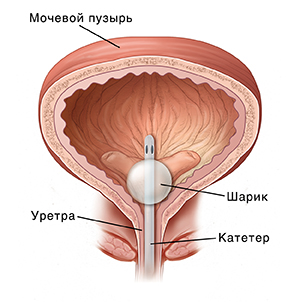 Поперечное сечение мочевого пузыря с установленным катетером.