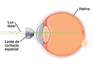 Vista lateral de un ojo que muestra la lente en el frente del ojo. Una luz láser se enfoca en la pared trasera interna del ojo.