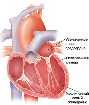 Поперечное сечение увеличенного сердца. Стенки сердца тонкие.