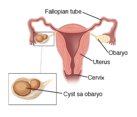 Larawan na nagpapakita ng hinati sa gitna na bahagi ng uterus, na may mga Fallopian tube, cervix, ovary, at cyst sa obaryo.