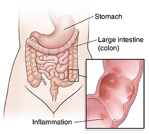 Vista frontal del contorno de una mujer donde se observa el tubo digestivo. En el recuadro se muestra un corte transversal del colon con enfermedad de Crohn.