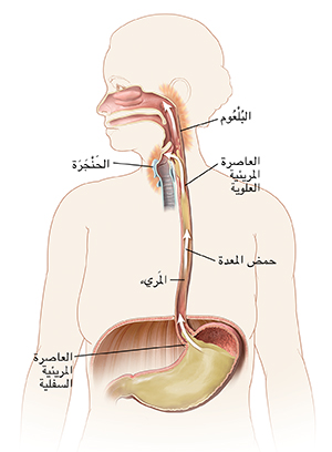 مخطط تفصيلي لامرأة يُظهر الفم والمريء والمعدة. الأسهم تُظهر تدفق حمض المعدة لأعلى المريء ليتسبب في تهيج الجزء الخلفي من الحلق.