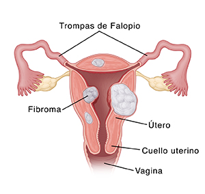 Vista frontal de un corte transversal de útero con fibromas uterinos.