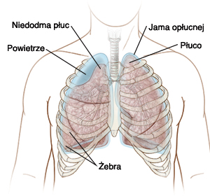 powietrze, niedodma płuc, ściana klatki piersiowej, płuco, jama opłucnej