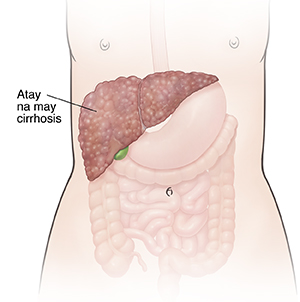 Harapang kuha ng balangkas ng babae na ipinakikita ang digestive system at atay na may cirrhosis.