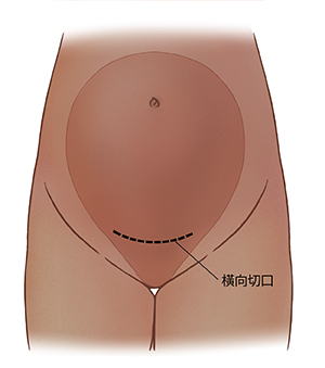 橫向切口圖