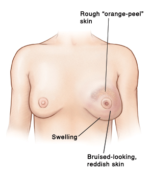 Vue de face de la poitrine d’une femme présentant une enflure, une peau rugueuse qui ressemble à l’écorce d’une orange et une peau rougeâtre d’apparence meurtrie sur un sein. Ce sein a un mamelon inversé. L’autre sein est normal.