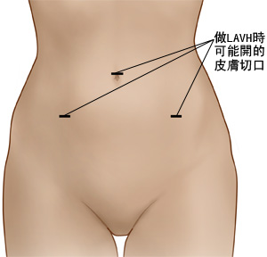 详图显示位于膈正下方的胃脏上端。食管穿过膈并与胃脏相连接。膈正下方的胃脏上部包裹在食管周围，并用缝线固定。