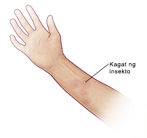 Kagat ng insekto