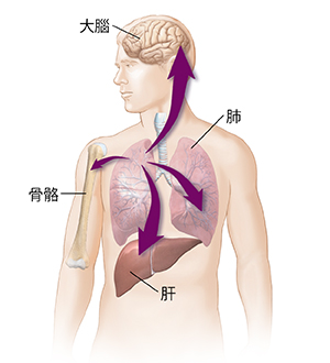 男性身體輪廓圖,箭頭顯示肺癌擴散到肝臟、另一個肺、骨骼和大腦。