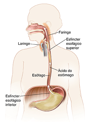 Contorno de uma mulher mostrando boca, esôfago e estômago. A seta mostra o ácido do estômago fluindo para o esôfago e irritando a parte posterior da garganta.