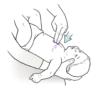 Primer plano de un adulto sosteniendo a un bebé boca abajo sobre su regazo y presionando el extremo inferior del esternón del bebé con dos dedos.