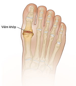 Nhìn từ trên xuống của bàn chân cho thấy viêm khớp ở khớp ngón chân cái.