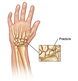 Main et poignet, paume vers le haut, montrant les os de la main et du poignet. L'encart montre un gros plan de la fracture d'un os du poignet.